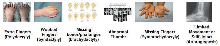 Hand Disorders Are Congenital