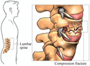 Vertebroplasty & Kyphoplasty