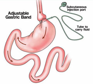 Laparoscopic Gastric Banding Surgery