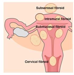 Laproscopic Fibroids Treatment