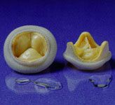 Heart Valve Replacements