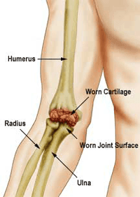 Elbow Joint Replacement Surgery