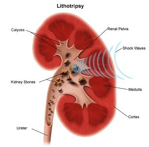 lithotripsy kidney