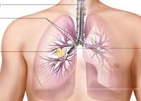 Lung and Pulmonary Tumors