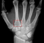 Hand Microsurgery