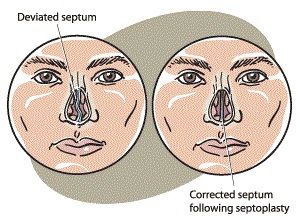 Septoplasty Procedure Description