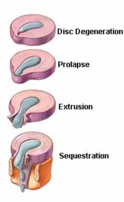 Stages of a Cervical Herniated Disc