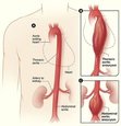 Aortic Aneurysm Surgery