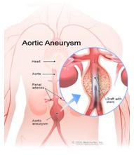 Best Aortic Aneurysm Repair Surgery Hospital India, Aortic Aneurysm Repair Surgery Symptoms, Aneurysm Repair Surgery, Aortic Aneurysm Repair Surgery Hospital India, Low Cost Aortic Aneurysm Repair Surgery India, Aortic Aneurysm Repair Surgery Specialist India, Aortic Aneurysm Repair Surgery Surgeons India