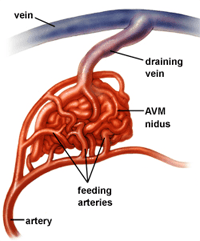 Arteriovenous Malformation