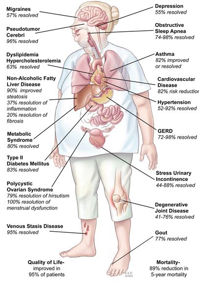 Best Hospital For Bariatric Surgery In India Best Weight