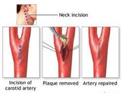 Carotid