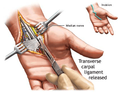 Carpal Tunnel Release Surgery