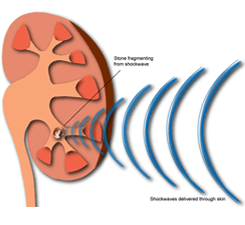 Treatment of Kidney Stones Surgery