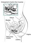 Urinary Incontinence