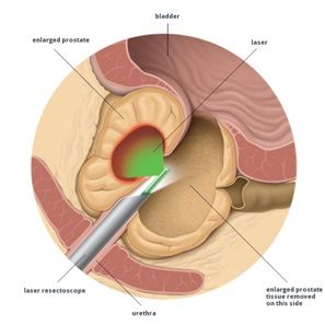 enlarged prostate surgery cost