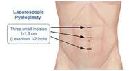 Laparoscopic Pyeloplasty