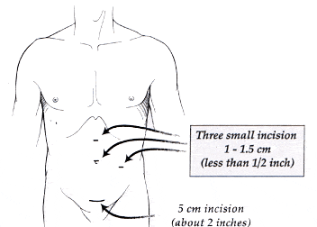Laparoscopic Radical Nephrectomy