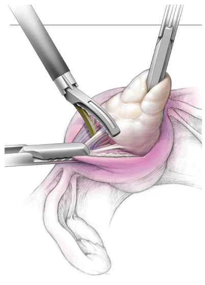 Laparoscopic Myomectomy