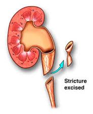 Pyeloplasty