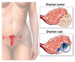  Ovarian Cancer  Treatment in India: A woman’s lifetime risk of dying from ovarian cancer is 1.1 per cent