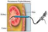 Percutaneous Nephrolithotomy