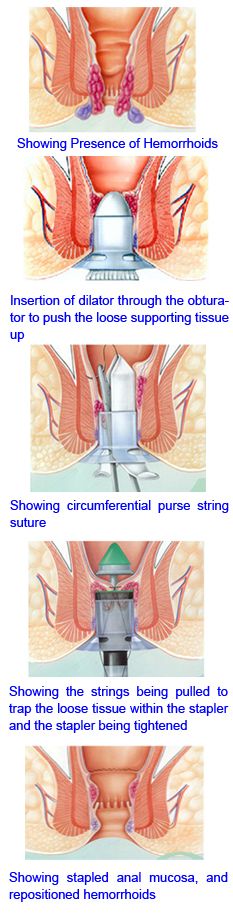 stapled hemorrhoidopexy