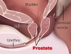 Prostate Cancer and Tumors