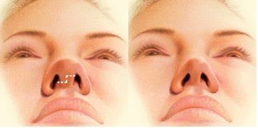 Rhinoplasty