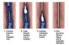 Sclerotherapy