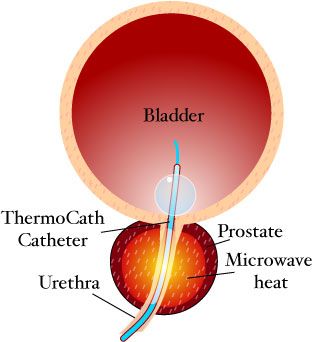 Advanced Treatments For Prostate Cancer In India Chemo Radiations Cyberknife Safemedtrip