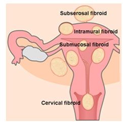 Uterine Fibroids