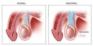 Laproscopic Varicolectomy in India - Signs, Syptoms, Causes