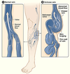 varicose veins treatments in India