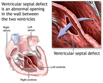 Ventricular Septal Defect