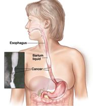 Esophageal