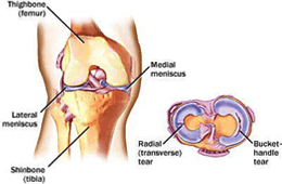  Meniscus Tear