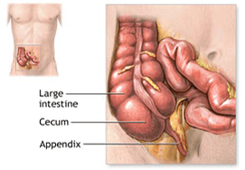 Laparoscopic Appendectomy Surgery