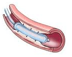 Interventional Cardiology Procedures for Treatment of Heart Diseases