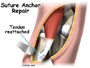 Endoscopic Carpal Tunnel Release