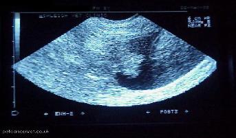 can bladder ultrasound detect cancer Updated