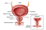 Bladder Cancer