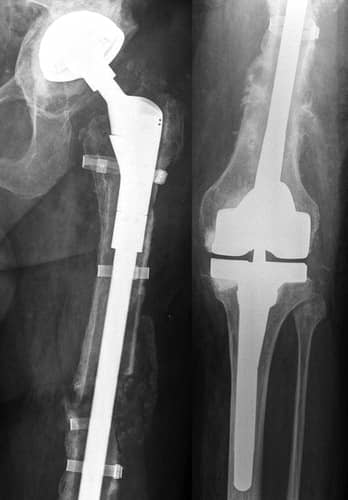 Femur Replacement