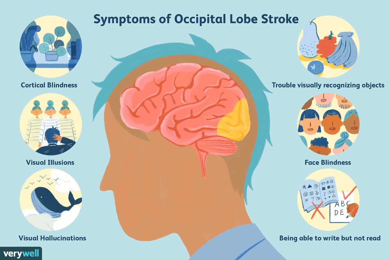 Brain Hemorrhage Diagram