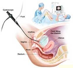 Bladder Cancer surgery