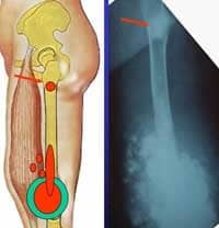 bone sarcoma of limbs