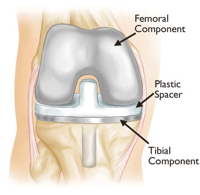 partial knee replacement