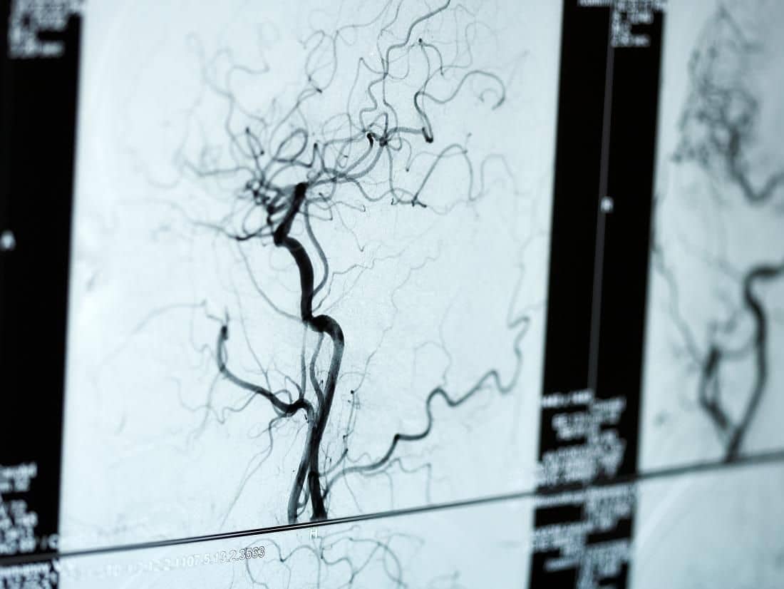 The diagnosis of brain haemorrhage depends