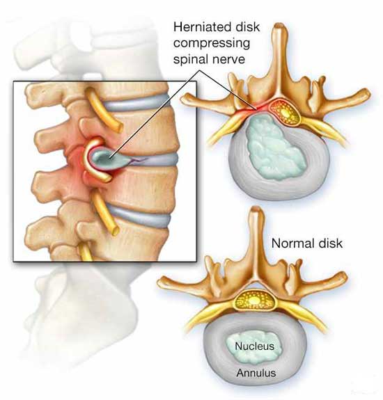 treatment for a slipped disc