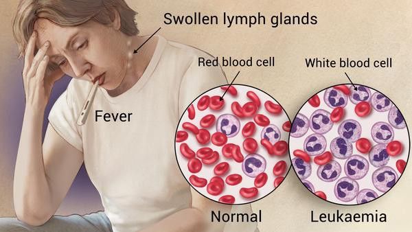 Leukaemia Cancer 